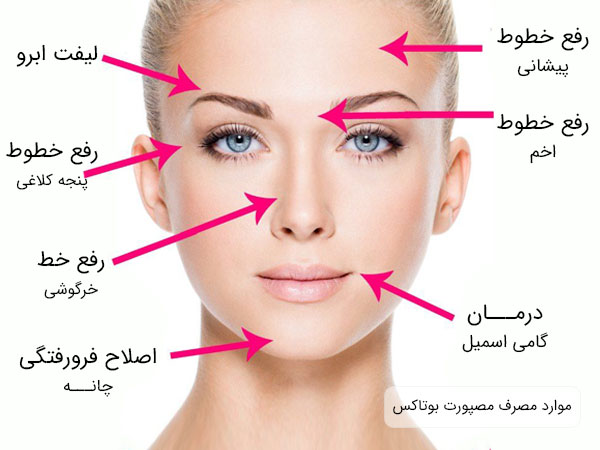 نواحی مختلف صورت یک خانم که می تواند با استفاده از مصرف بوتاکس برند مصپورت درمان و رفع شود .