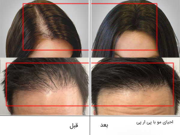 تصویر قبل و بعد تزریق پی ار پی مو برای یک خانم و یک اقا. تغییرات کاملا چشمگیر می باشد