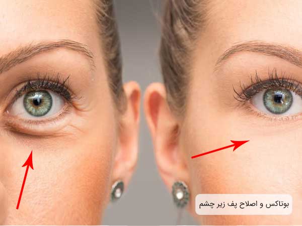 تصویر زیر و اطراف چشم یک خانم قبل و بعد از تزریق بوتاکس صورت برای جوانسازی . زمینه تصویر کدر و تاریک می باشد