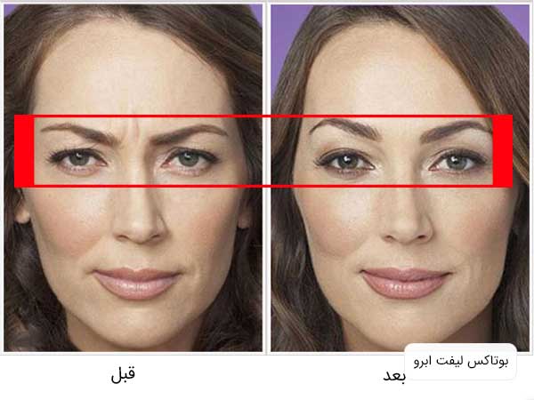 تصویر صورت یک خانم قبل و بعد از تزریق بوتاکس صورت برای بالابردن اثرو و رفع افتادگی آن . تصویر خانم در نمای بسته می باشد