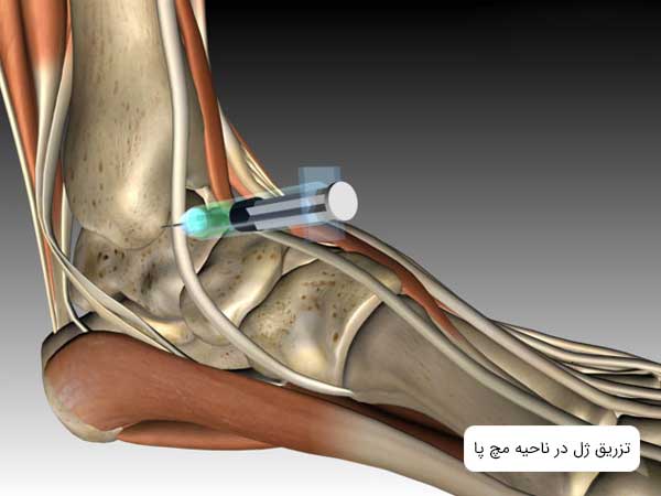 تصویر پای انیمیشنی در حال تزریق ژل برای جلوگیری از التهاب و درد.