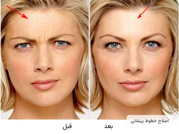 تصویر قبل و بعد تزریق بوتاکس صورت توسط یک خانم در ناحیه پیشانی خود . تصویر بسته می باشد و بک گراند سفید .