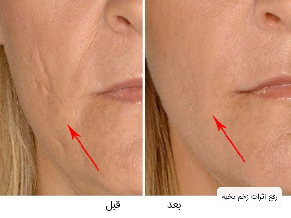 تصویری از صورت یک خانم زیبا قبل و بعد انجام میکرونیدلینگ پوست صورت برای رفع اثرات مانده از زخم بخیه . زمینه تصویر سفید می باشد