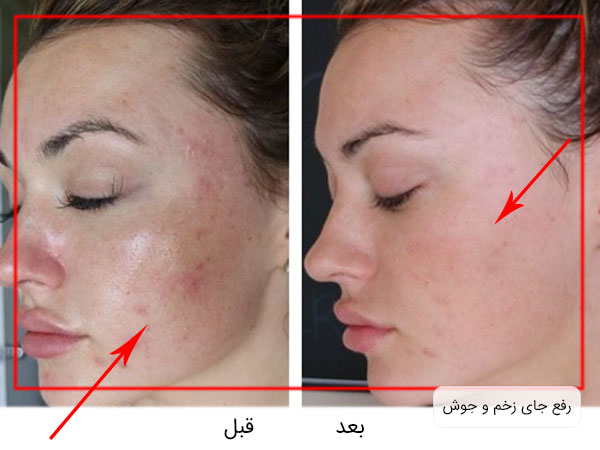 تصویر قبل و بعد از استفاده میکرونیدلینگ برای صورت . جای جوش و زخم پس استفاده از روش میکرونیدلینگ در مان شده است
