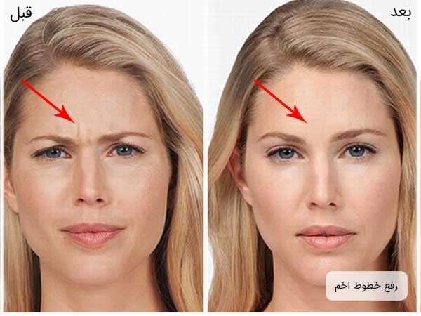 تصویری از خطوط پاخم بین دو ابروی یک خانم قبل و بعد از تزریق بوتاکس صورت برای جوانسازی . هر دو تصویر پس زمینه سفید دارند