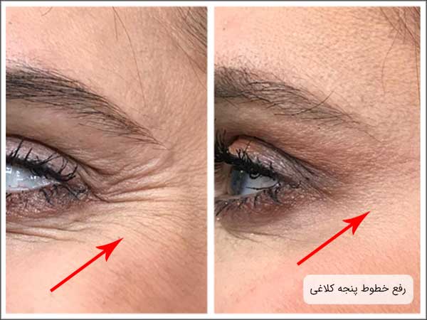 تصویری از خطوط پنجه کلاغی اطراف چشم یک خانم قبل و بعد از تزریق بوتاکس برای جوانسازی . هر دو تصویر از نمای نیمرخ گرفته شده است