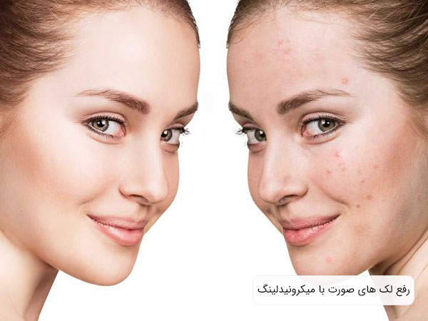 تصویری از صورت یک خانم زیبا قبل و بعد انجام میکرونیدلینگ پوست صورت. زمینه تصویر سفید می باشد