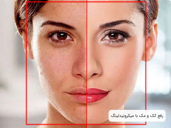 تصویر دو نیمه صورت یک خانم قبل و بعد استفاده از روش میکرونیدلینگ برای رفع کک و مک موجود در صورت