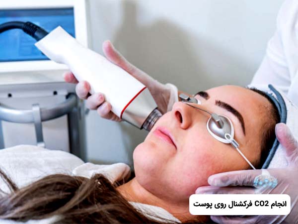 خانم عينک مخصوص عمل را به چشم زده و خوابيده است. پزشک در حال درمان و زيباسازي پوست خانم با استفاده از ليزر CO2 فرکشنال مي باشد.