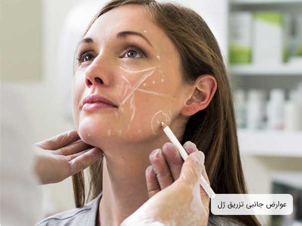 پزشک در حال رسم خطوط عوارض جانبی روی صورت یک خانم که قرار است از روش تزریق ژل برای زیبایی استفاده کند . پزشک دستکش در دست ندارد
