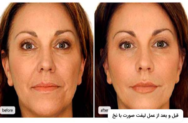 در تصوير دو عکس از صورت يک خانم را مشاهده مي کنيد که مربوط به قبل و بعد از عمل با ليفت نخ مي باشد.