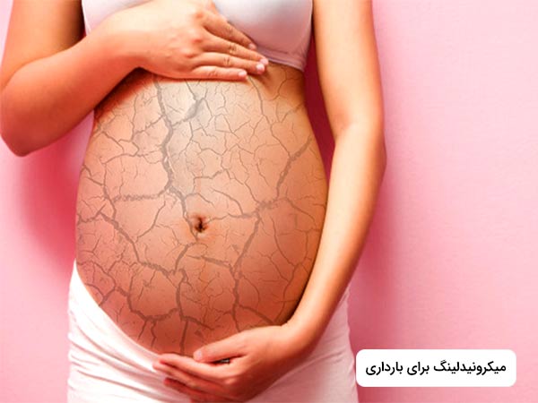 در تصور بر روي شکم يک خانم ترک هايي وجود دارد که به دليل بارداري ايجاد شده است.