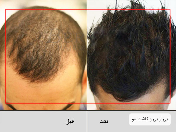 تصویر قبل و بعد استفاده از پی ار پی در کاشت و پیوند مو . بک گراند تصویر سفید بوده و از بالای سر دو شخص عکسبرداری شده است.