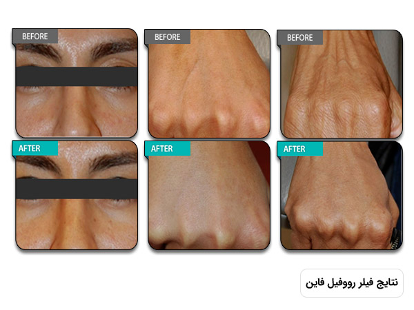 نمایش تاثیرات استفاده از ژل زیر چشم رووفيل فاين کره بر روي دست و زير چشم