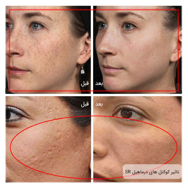 قبل و بعد صورت دو خانم بعد از استفاده از کوکتل های مغذی SR مزو های درماهیل