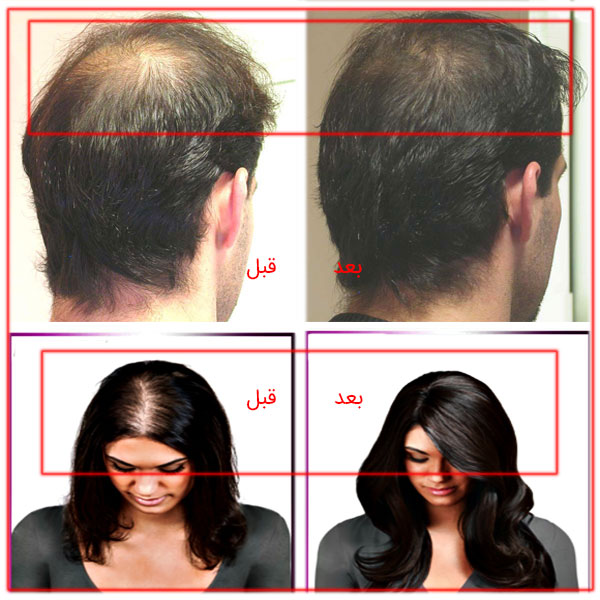 تصویر قبل و بعد از استفاده از کوکتل های مغذی اچ ال برای ترمیم و پرپشت سازی مو. 