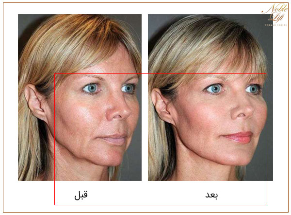 تصویر قبل و بعد از استفاده از نخ لیفت و تاثیر آن در صورت یک خانم
