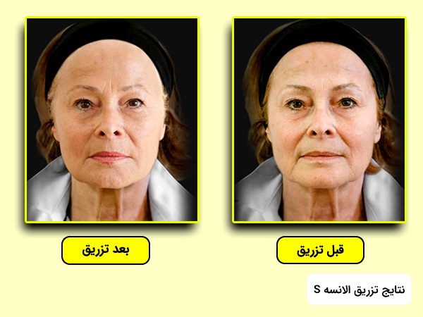 اثرات قبل و بعد از تزريق ژل خط خنده الانسه به پوست صورت مدل اس