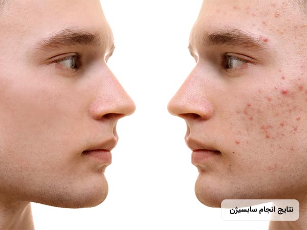 نتايج اثرات انجام سابسيژن روي پوست صورت