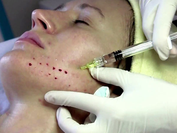 نحوه انجام و تزریق مزوژل بر روی صورت یک خانم خوابیده بر روی تخت مطب دکتر