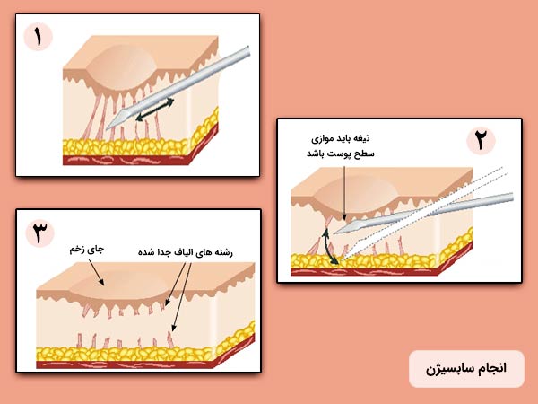 مراحل مکانيزم عملکرد سابسيژن به منظور درمان اسکار جاي جوش