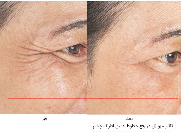 قبل و بعد استفاده از مزو ژل برای رفع خطوط اطراف و زیر چشم در تصویر کاملا مشهود می باشد