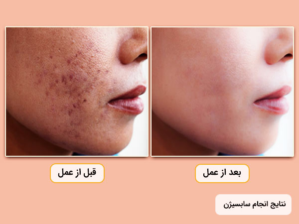 نتايج قبل و بعد از انجام سابسيژن بر روي پوست صورت براي رفع جاي جوش و زخم