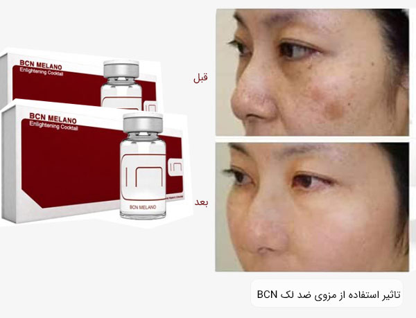 تصاویر صورت قبل و بعد از استفاده از کوکتل BCN MELANO بر روی پوست صورت با زمینه سفید مشخص می باشد.