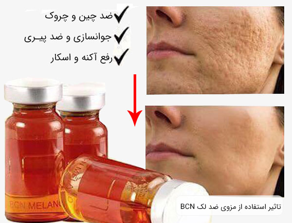 تاثیر استفاده از کوکتل ضد لک BCN ملانو و لومن بر روی پوست