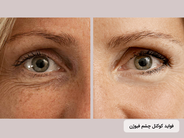 تاثیر کوکتل دور چشم فيوژن اسپانيا F-EYE CONTOUR برای جوانسازی اطراف چشم و صورت