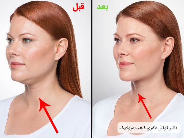 خرید کوکتل غبغب و بازو مزولایک اسپانیا با بهترین قیمت موجود در بازار
