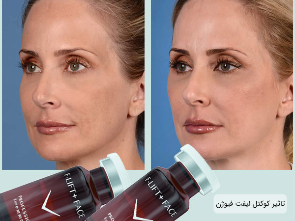قبل و بعد از استفاده از کوکتل لیفت فیوژن