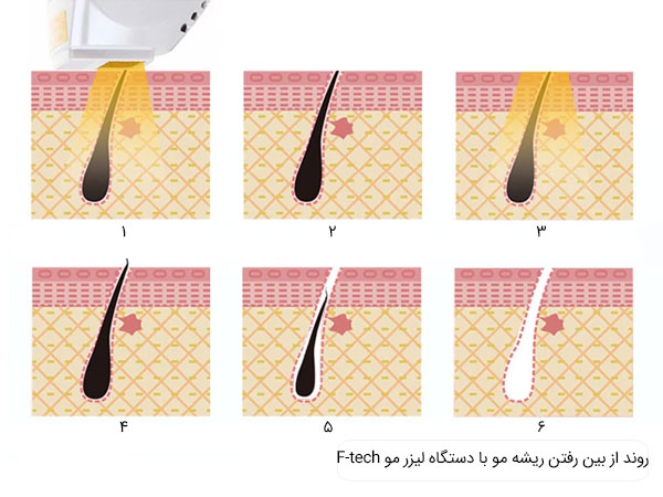 روند نابود شدن ریشه مو های زائد با استفاده از دستگاه لیزر مو Ftec