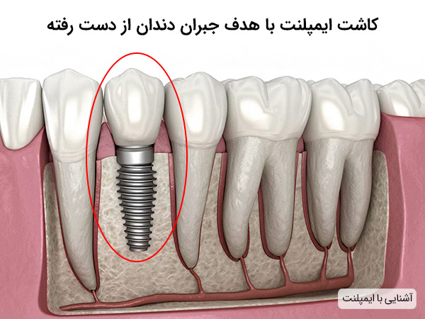 ایمپلنت دندان چیست 