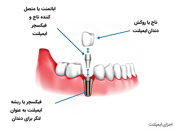 اجزای ایمپلنت دندان برای زیبایی دندان