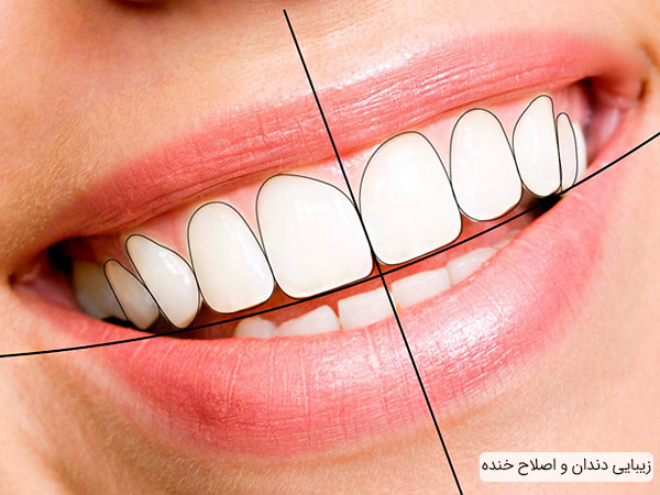زیبا سازی دندان با هدف اصلاح الگوی خنده