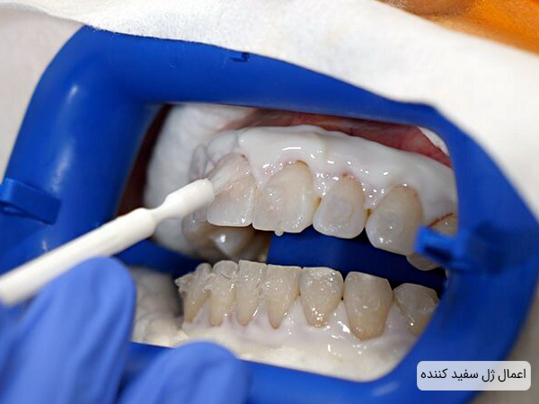 بلیچینگ دندان به روش کلینیکی