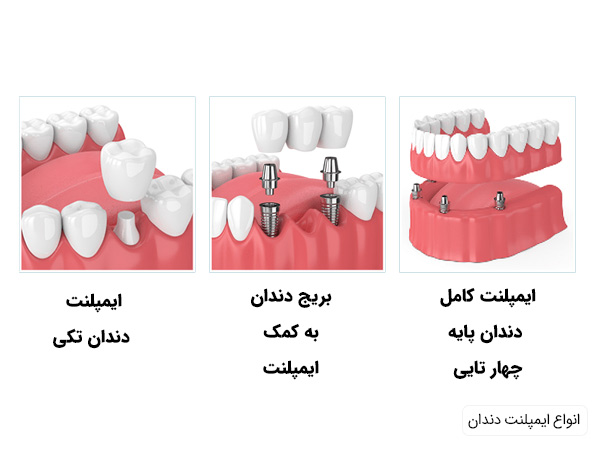 انواع ایمپلنت دندانی