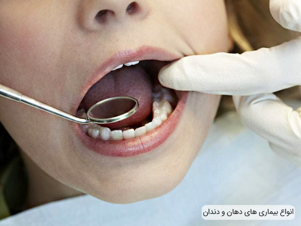 انواع بیماری های دهان و دندان