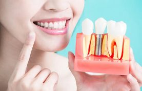 ایمپلنت دندان چیست و انواع آن