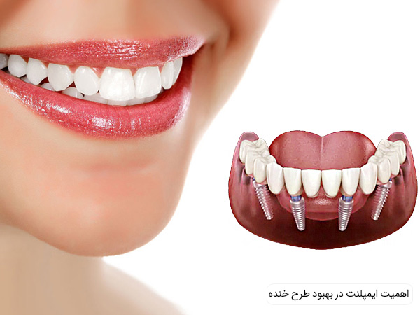 اهمیت امپلنت دندان در بهبود زیبایی خط خنده