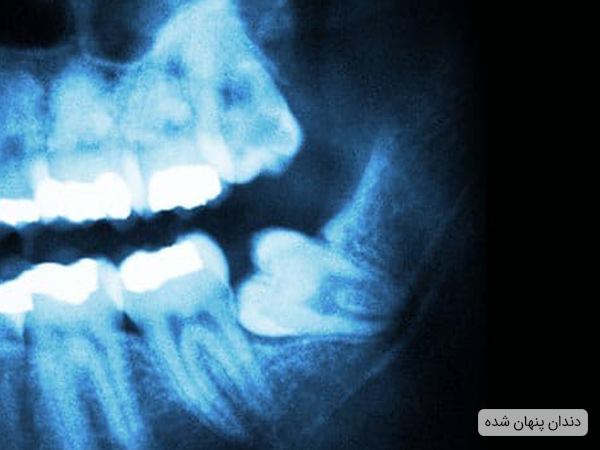دندان پتهان شده نظیر دندان عقل که باعث درد می شود