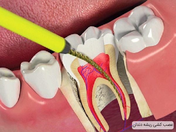 عصب کشی و خالی سازی ریشه دندان