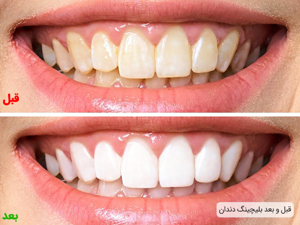 قبل و بعد از بلیچینک دندان