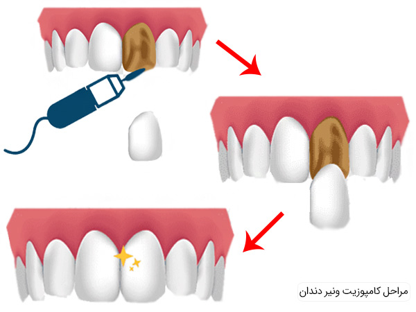 مراحل مختلف کامپوزیت ونیر دندان