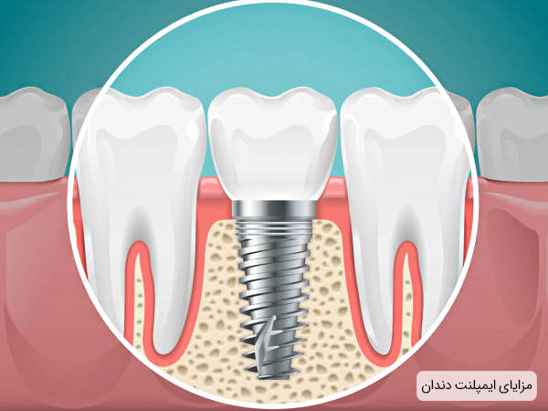 مزایا ایمپلنت دندان