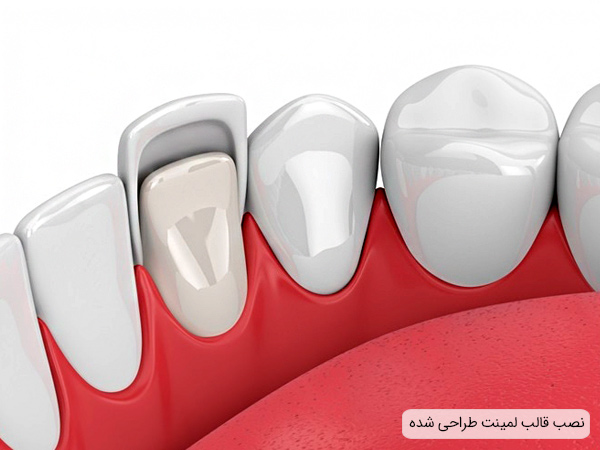 مراحل لمینت دندان و نصب آن
