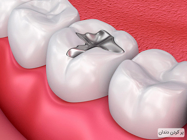 پر کردن دندان برای جلوگیری از تخریب بیشتر دندان