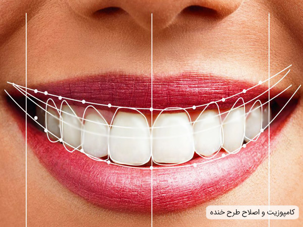 کامپوزیت دندان با هدف اصلاح طرح خنده