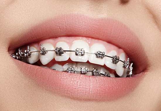 آشنایی با ارتودنسی دندان